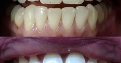 Teeth: दांतों के पीलेपन से छुटकारा पाने के लिए घरेलू नुस्खे