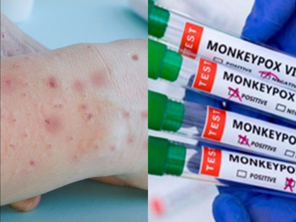 Monkeypox के भारत में पहले मामले की पुष्टि हुई